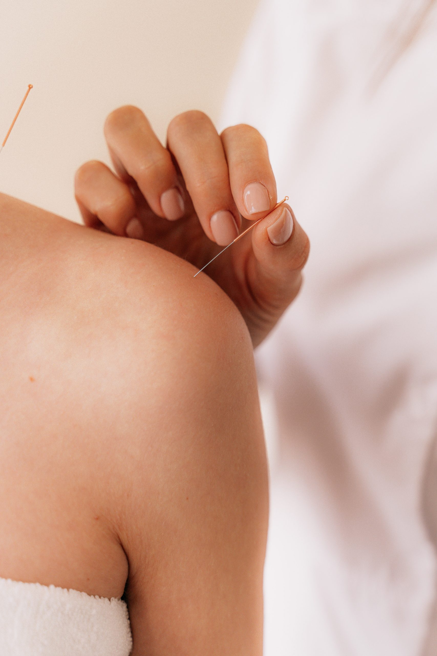 terapia acupuntura en Zaragoza