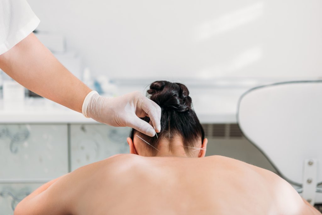 terapia alternativa acupuntura en centro de estética y bienestar Zaragoza